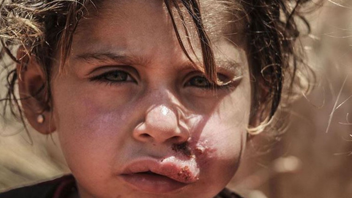 İdlib'deki sığınmacı kamplarında şark çıbanı hastalığı yayılıyor