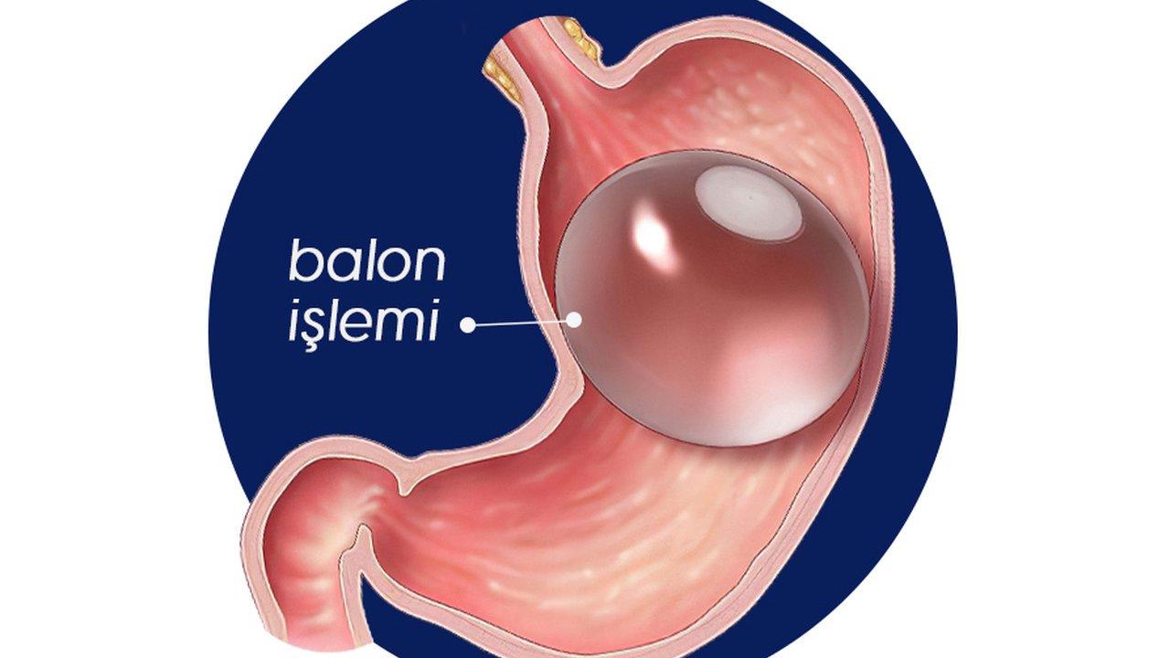 Mide balonu nedir ve fiyatları ne kadardır?