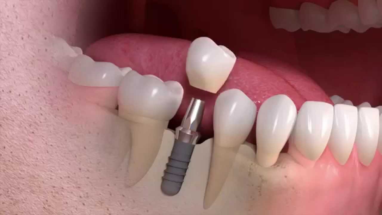 implant-pic.jpg