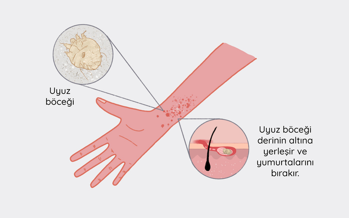 uyuz-bocegi-hastaligi.jpg