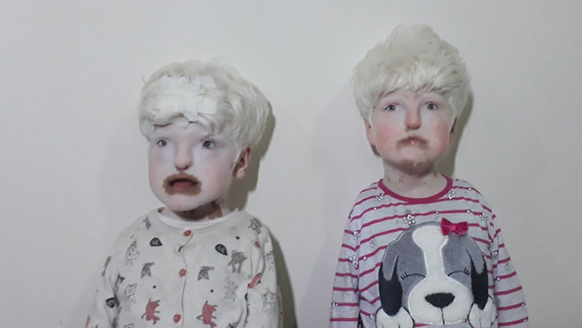 Albino Kardeşler Yardım Bekliyor