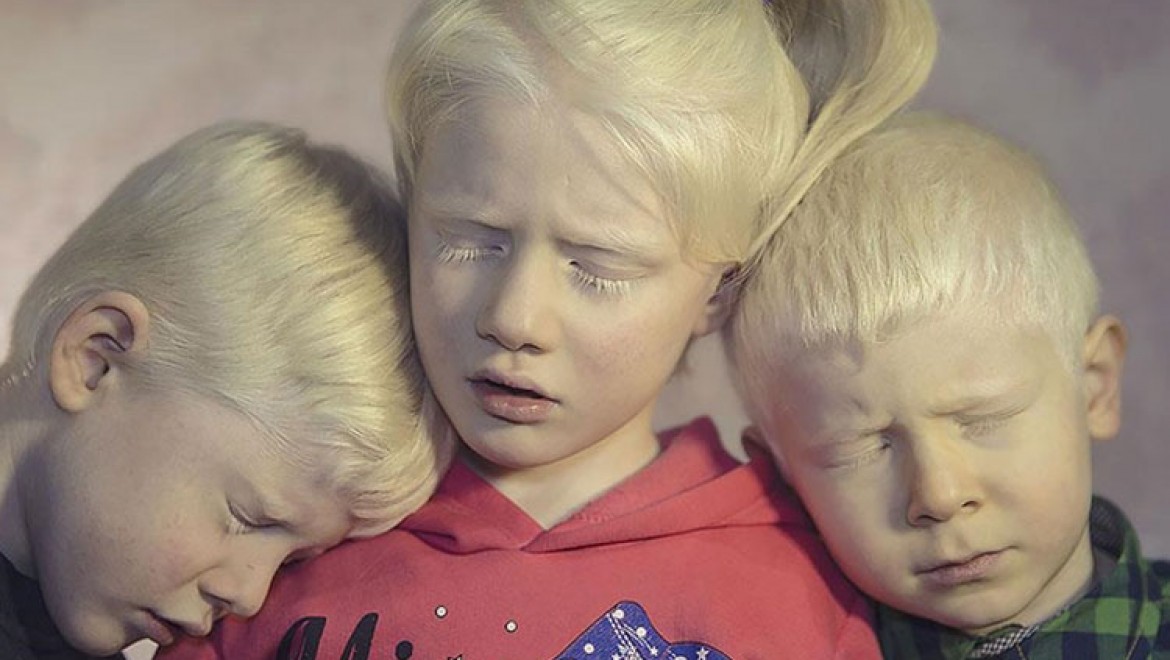 Albinizmli bireyler güneşten koruyucu kremleri için devletten destek bekliyor